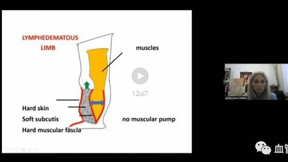 ICC 2020年度线上学术会议 静脉淋巴学和压力治疗第二期第一课程
